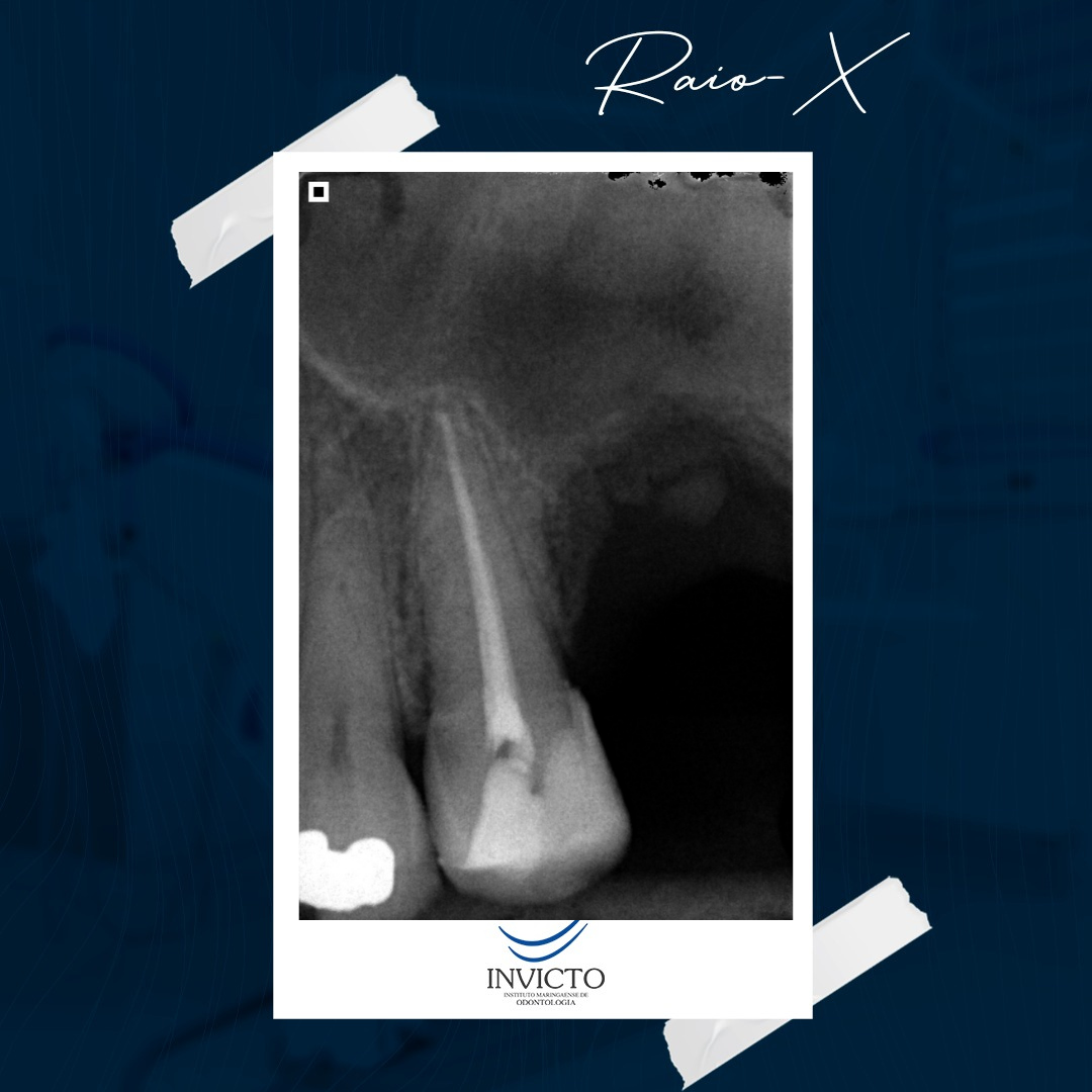 Endoloft - O espaço da Endodontia - Nossa aluna Dra @cauaneteofilo ...