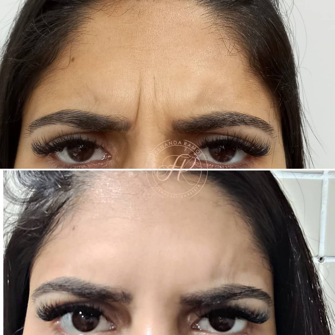 Dra Fernanda - a ruga da glabela é primordialmente o que... | Facebook