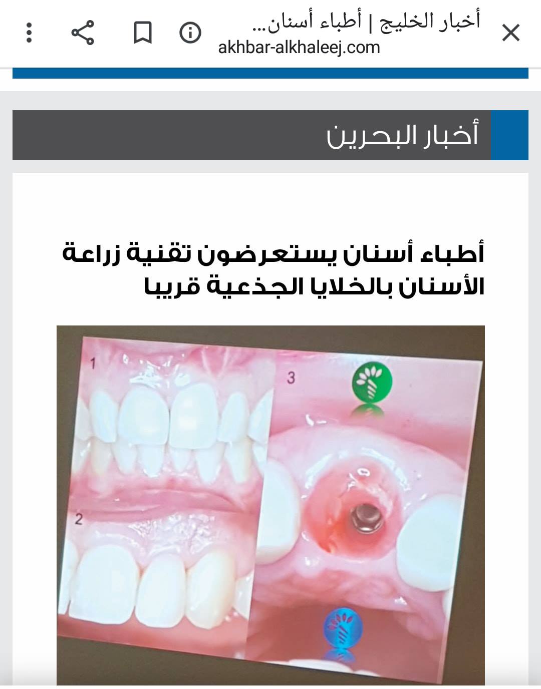 زراعة الخلايا الجذعية الذاتيه Global Care Surgery