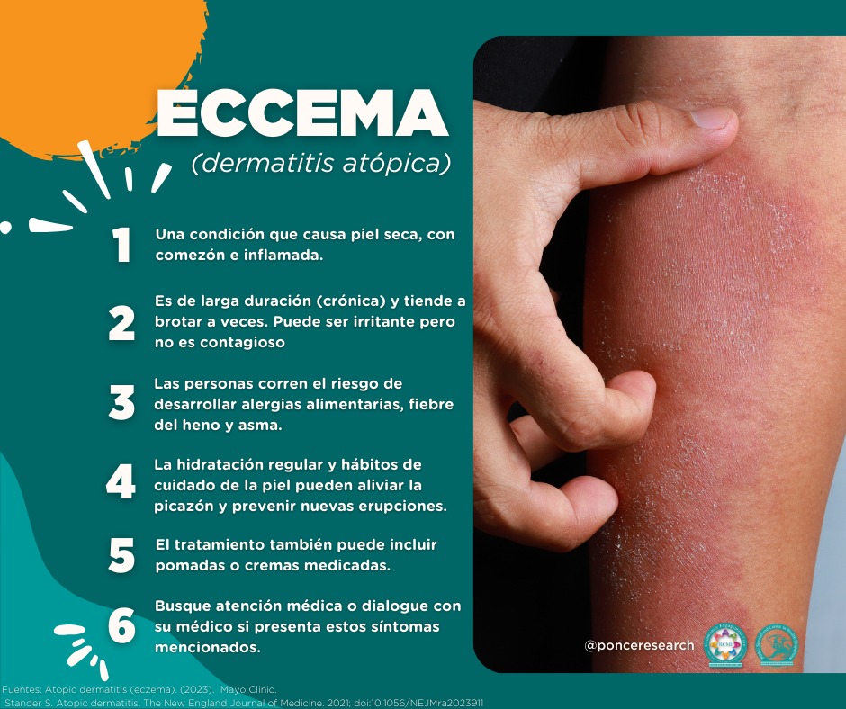El eccema, también conocido... - Ponce Research Institute