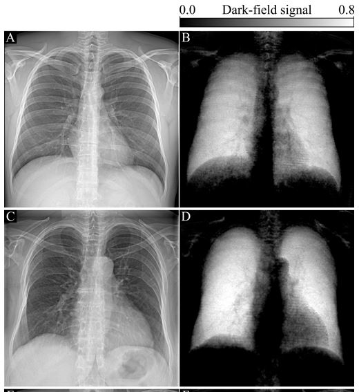 Promed - Advancement in X-ray technologies : X-ray Dark-Field Chest ...