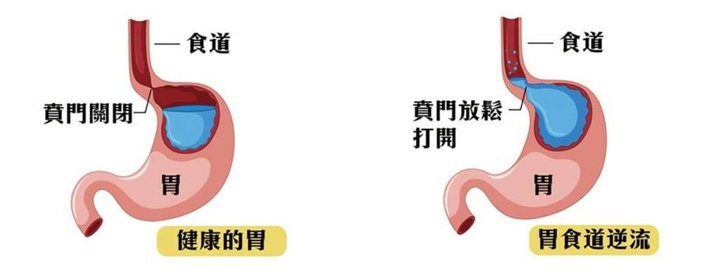 阿斌保險 - 胃食道逆流疾病，是指因為下食道括約肌功能失調，導致胃內容物逆流至食道，並產生不舒服的症狀及併發症的疾病。...