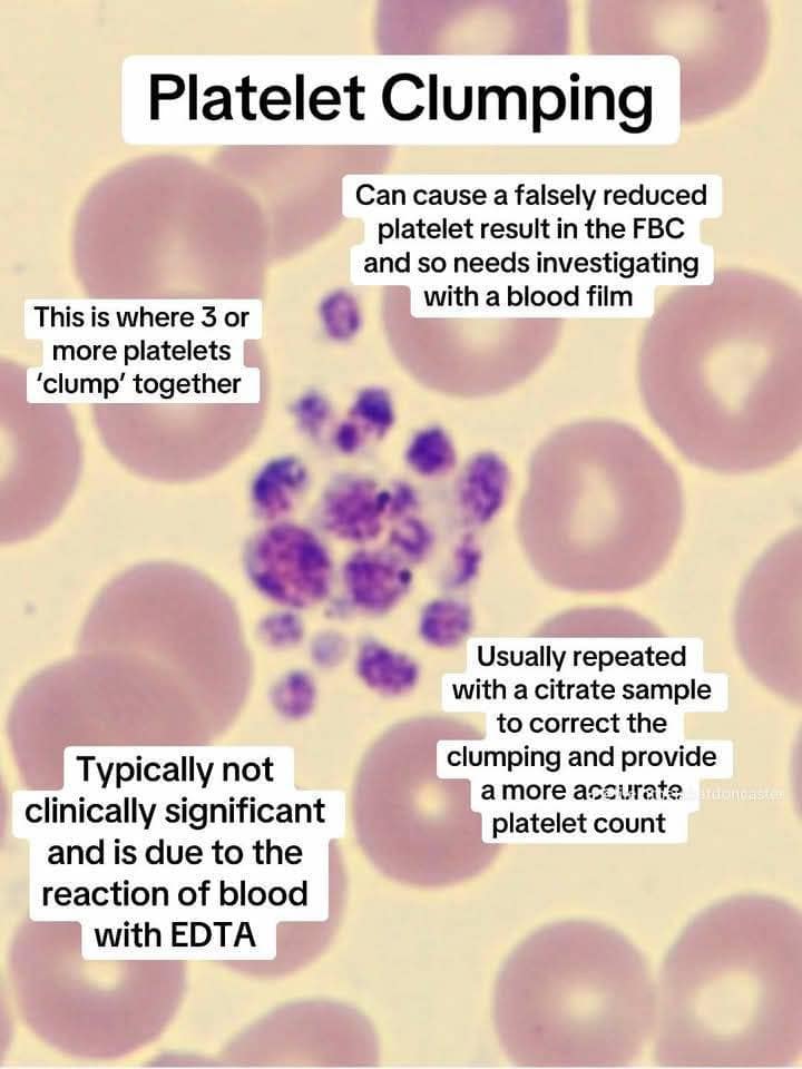 Hematology | 🩸 Platelets Clumping (Clot or Partial Clot) | Facebook