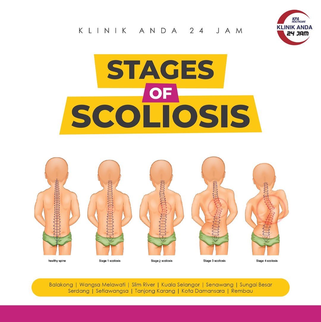 🚶🏻🚶🏻‍♀️🚶🏻‍♂️SCOLIOSIS🚶🏻... - Klinik ANDA Wangsa Melawati 24JAM