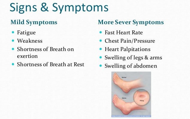 Congestive Heart Failure Signs And Symptoms Signs For Congestive Heart