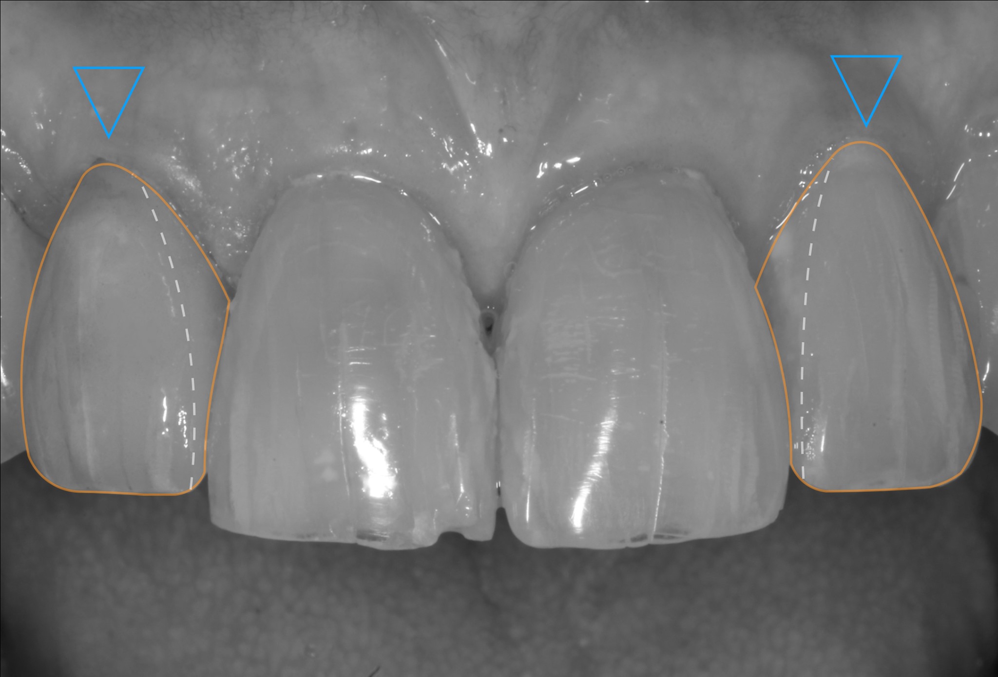 Achieving white and pink esthetics in restorative dentistry