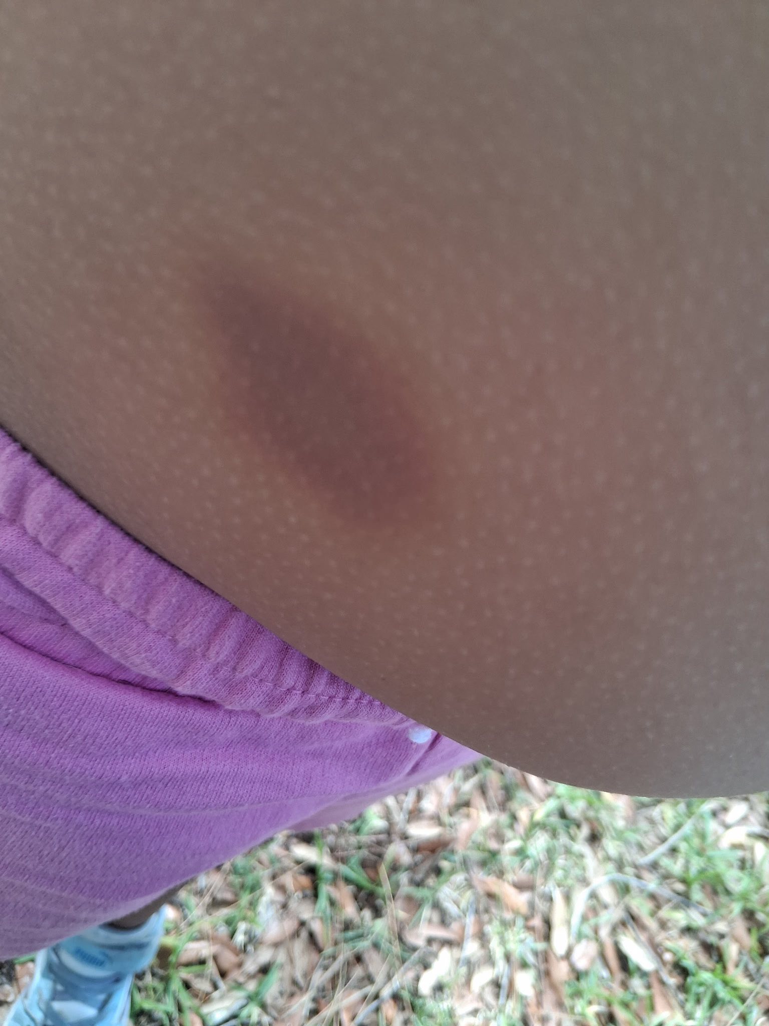 Should I report the bruise to my son's special education school?