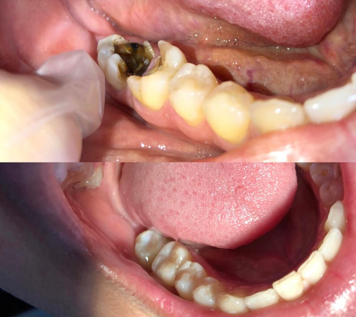 -Restaurações posterior, coroa... - Oral Dlin Odontologia