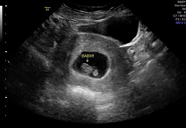 Ivyonna - “Wait until 12 weeks.” “Wait until the second trimester ...