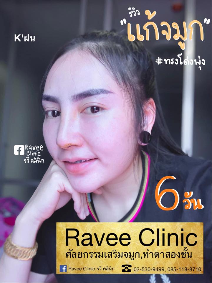อัพเดทความสวยวันที่ 6 ของคุณฝน... - Ravee Clinic - รวี คลินิก