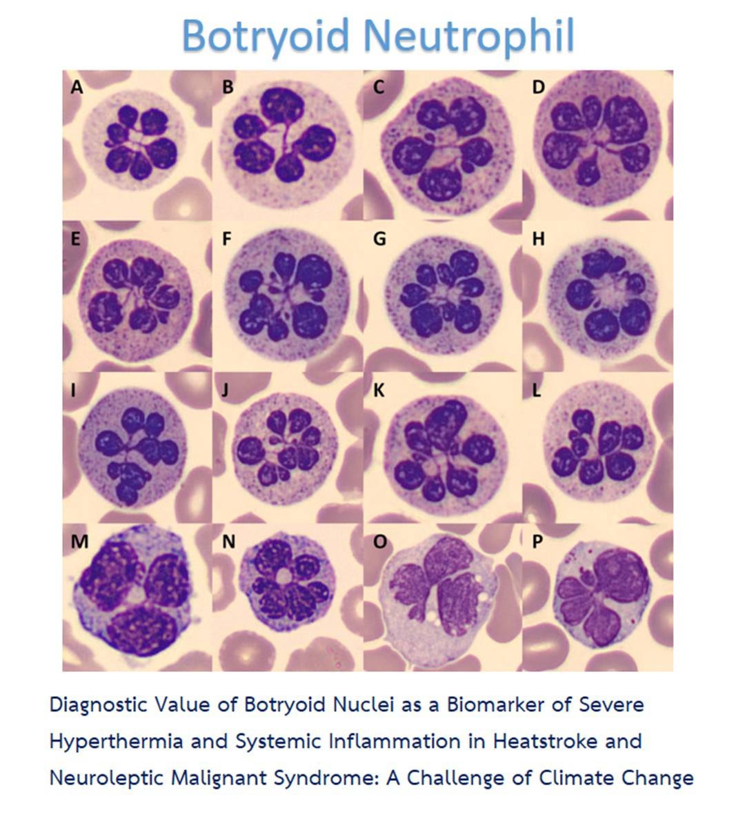 Hematology | 🍇Botryoid Neutrophil🍇 | Facebook
