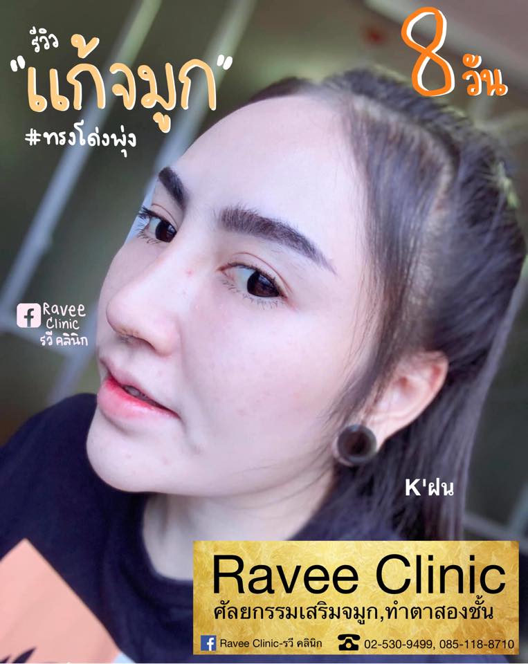 อัพเดทความสวยวันที่ 8 ของคุณฝน... - Ravee Clinic - รวี คลินิก