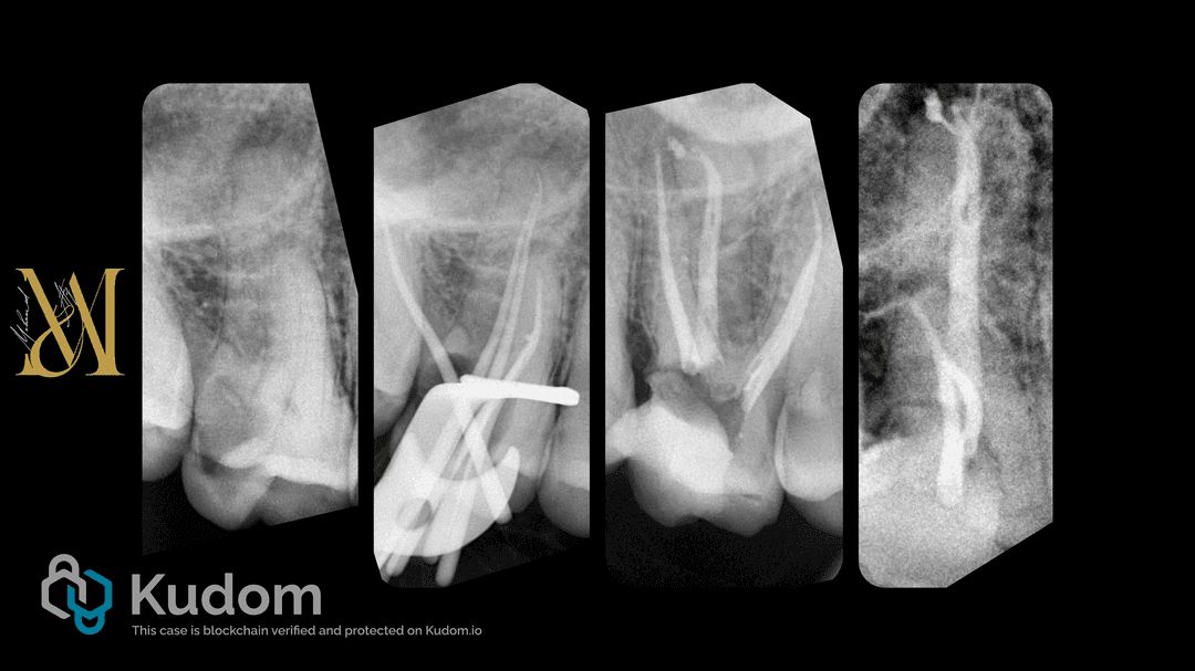Mohamed - 𝐕𝐞𝐫𝐲 𝐝𝐞𝐞𝐩 𝐚𝐩𝐢𝐜𝐚𝐥 𝐬𝐩𝐥𝐢𝐭. Single visit RCT of tooth no.16 ...