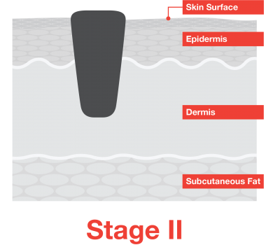 What is stage 2 melanoma? Stage II... - Melanoma On My Mind | Facebook