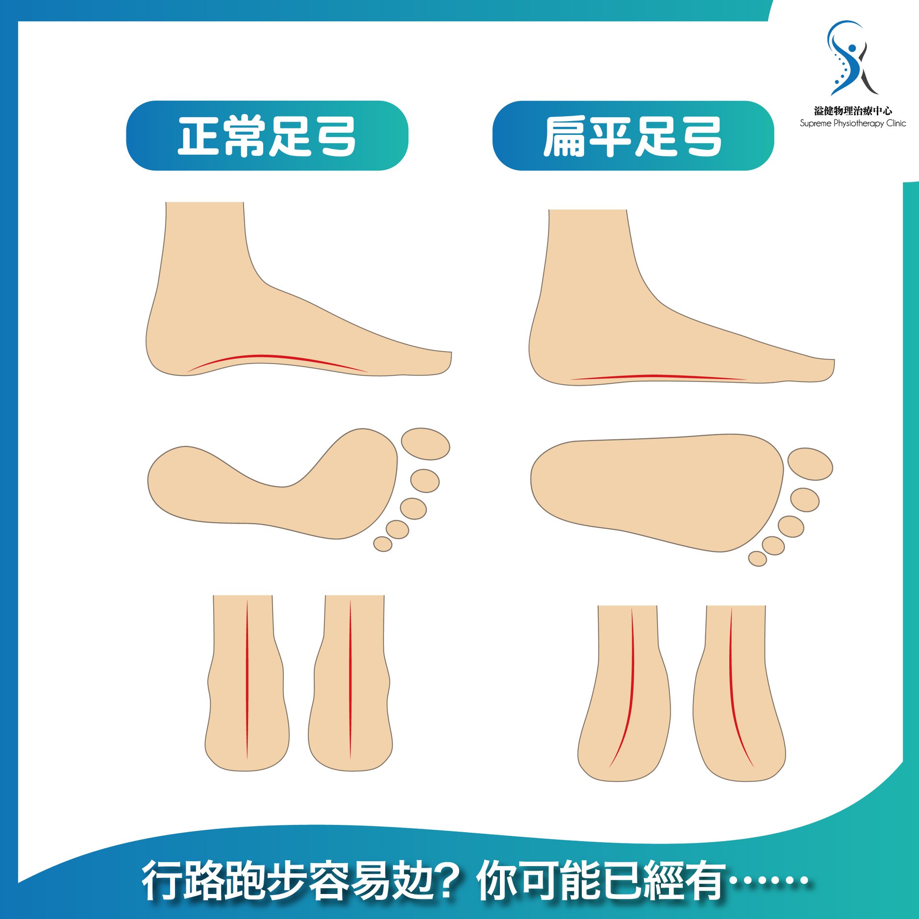 平時行路或者跑步嘅時候🏃🏻‍♂️，如果對腳好容易就覺得攰，除咗體能... - Supreme Physio 溢健物理治療中心