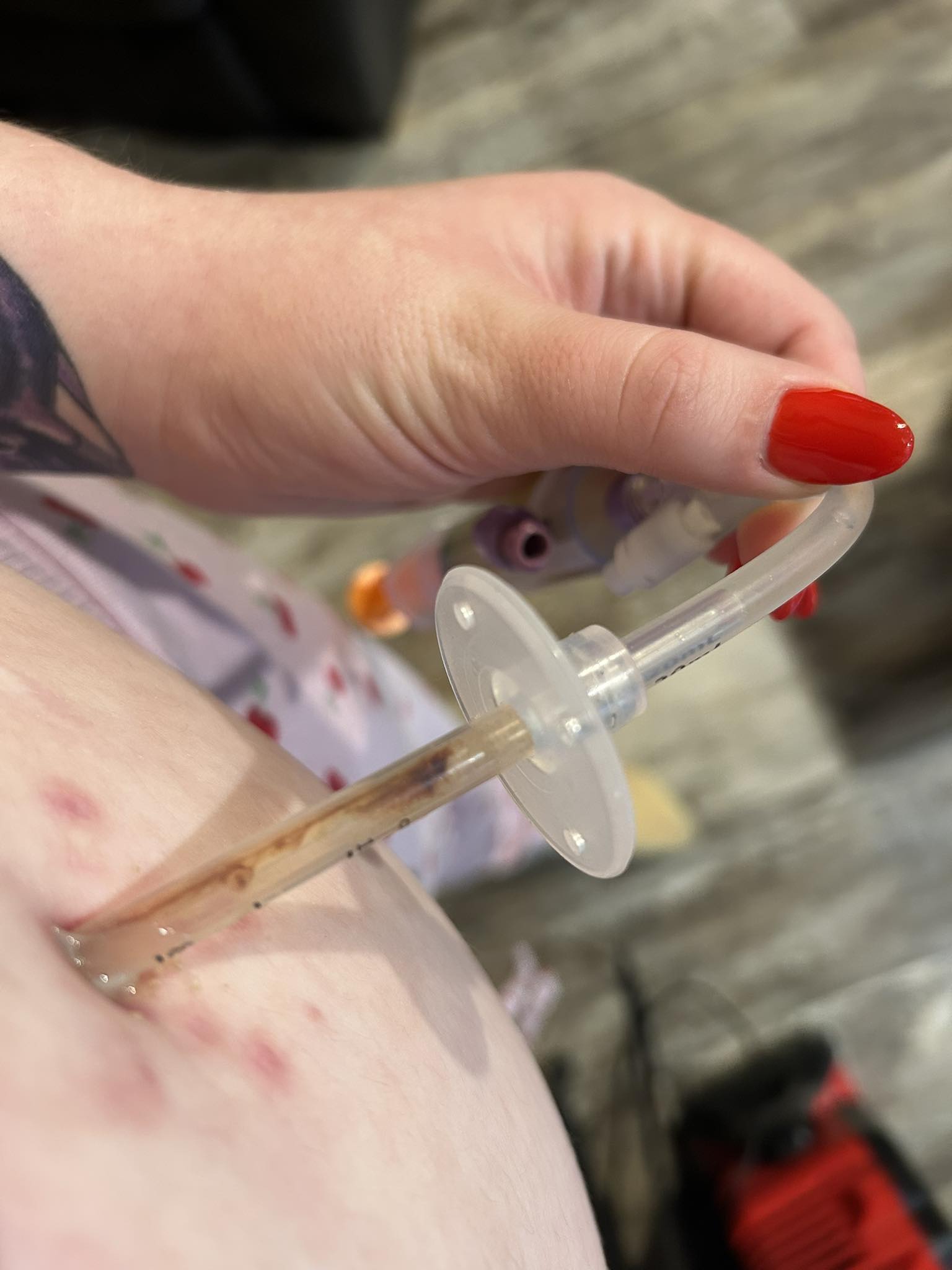 Is dark red stool a sign of blood in adults with feeding tubes?