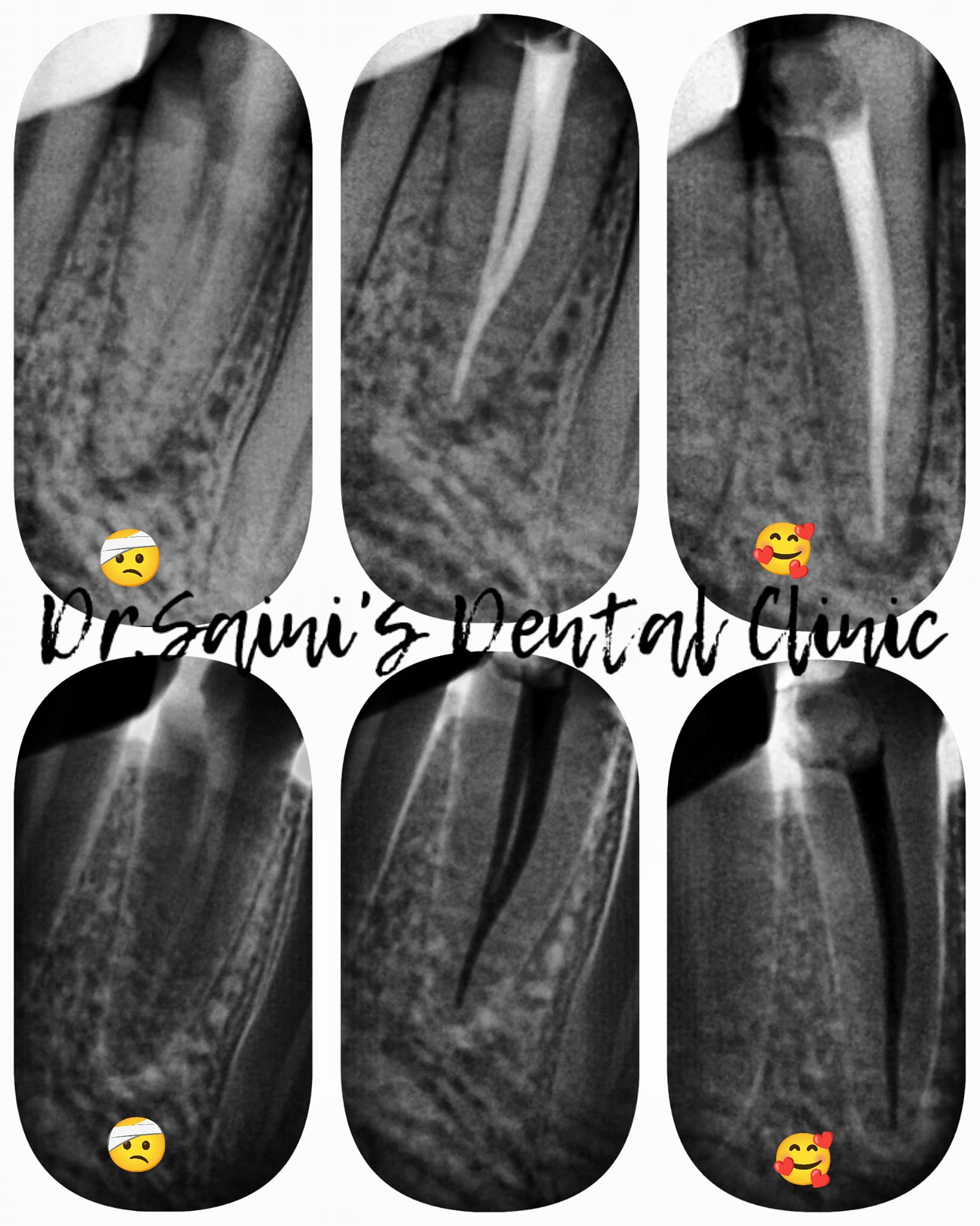 THE CASE OF SINGLE SITTING ROOT... - Dr.Saini's Dental Clinic