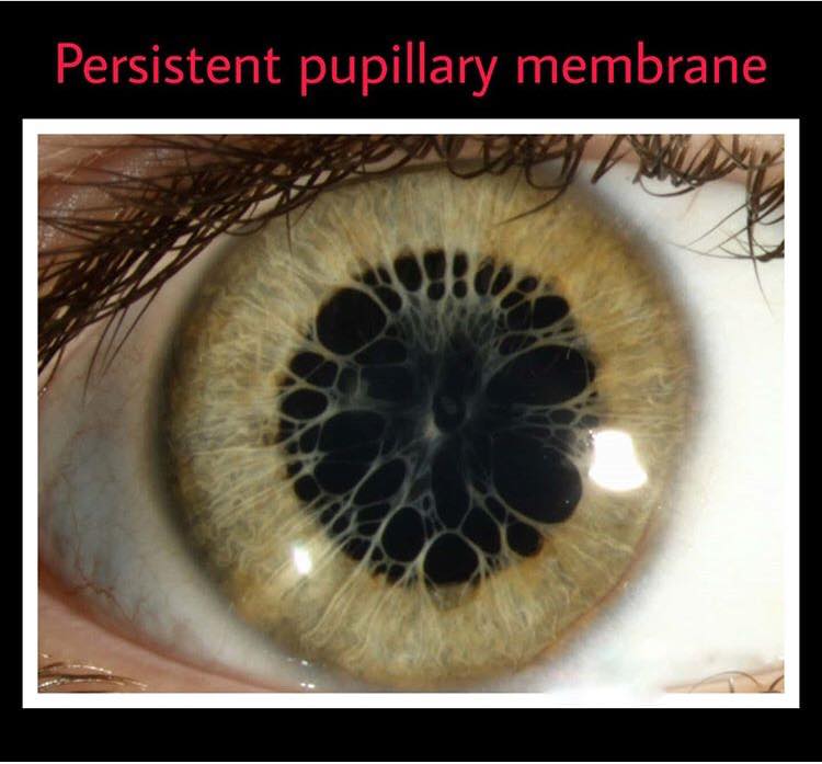 Persistent Pupillary... - Ophthalmology-Notes And Synopses
