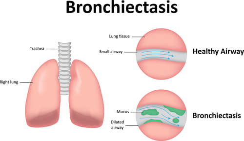 glutathione bronchiectasis Trouble clearing mucus from your lungs? It could be bronchiectasis. With the right care, you can still stay active. Learn more at lung.org/ #bronchiectasis #chronicillness GHK-Cu Hair Growth Guide: Expiry:3 x 10 tablets/ 11-27 Elasticity Support