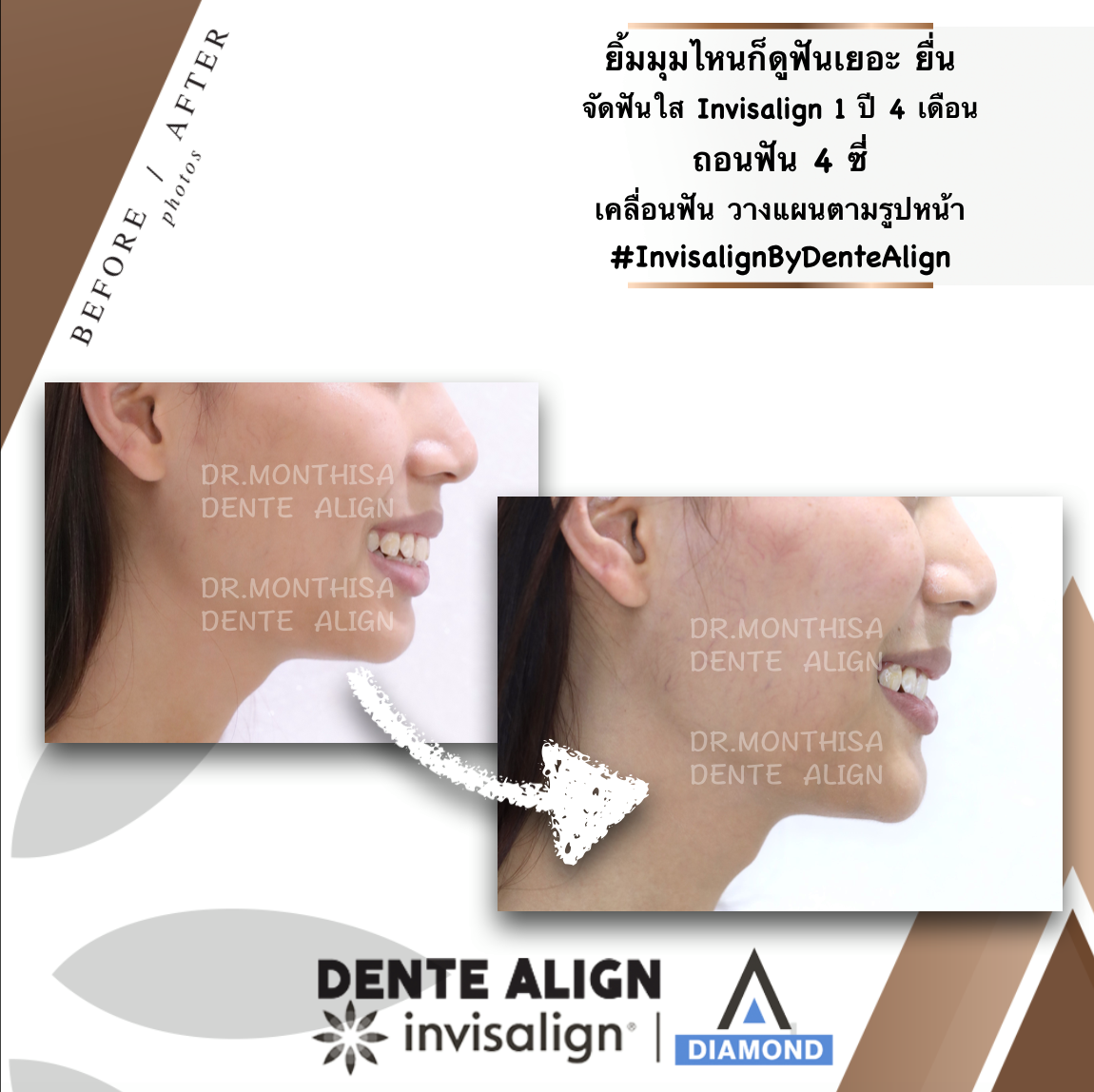 ยิ้มแล้ว... - Dente Align Clinic - Invisalign Diamond Provider