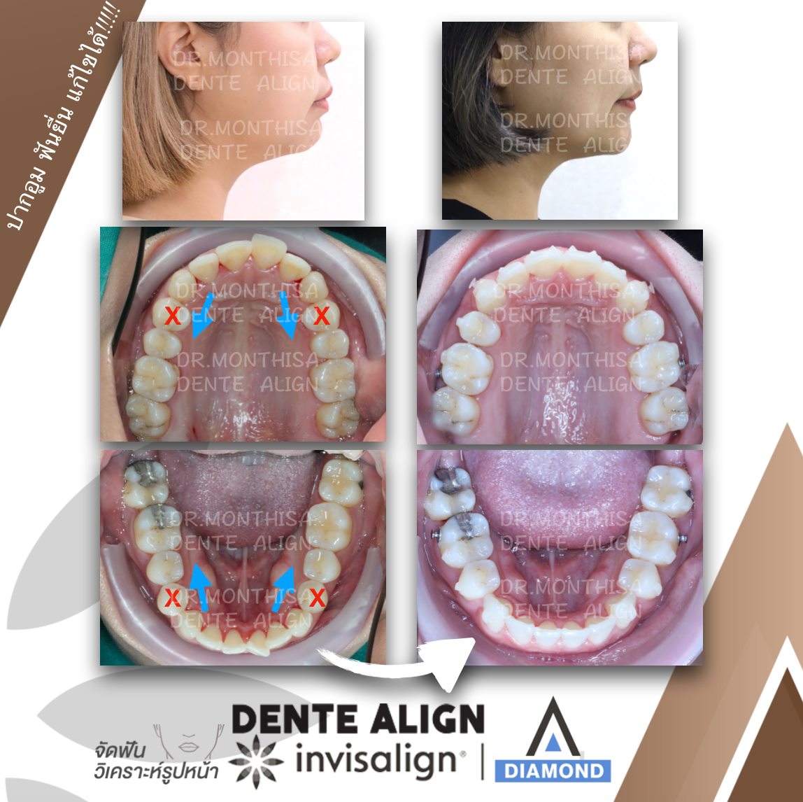 ฟันยื่น... - Dente Align Clinic - Invisalign Diamond Provider