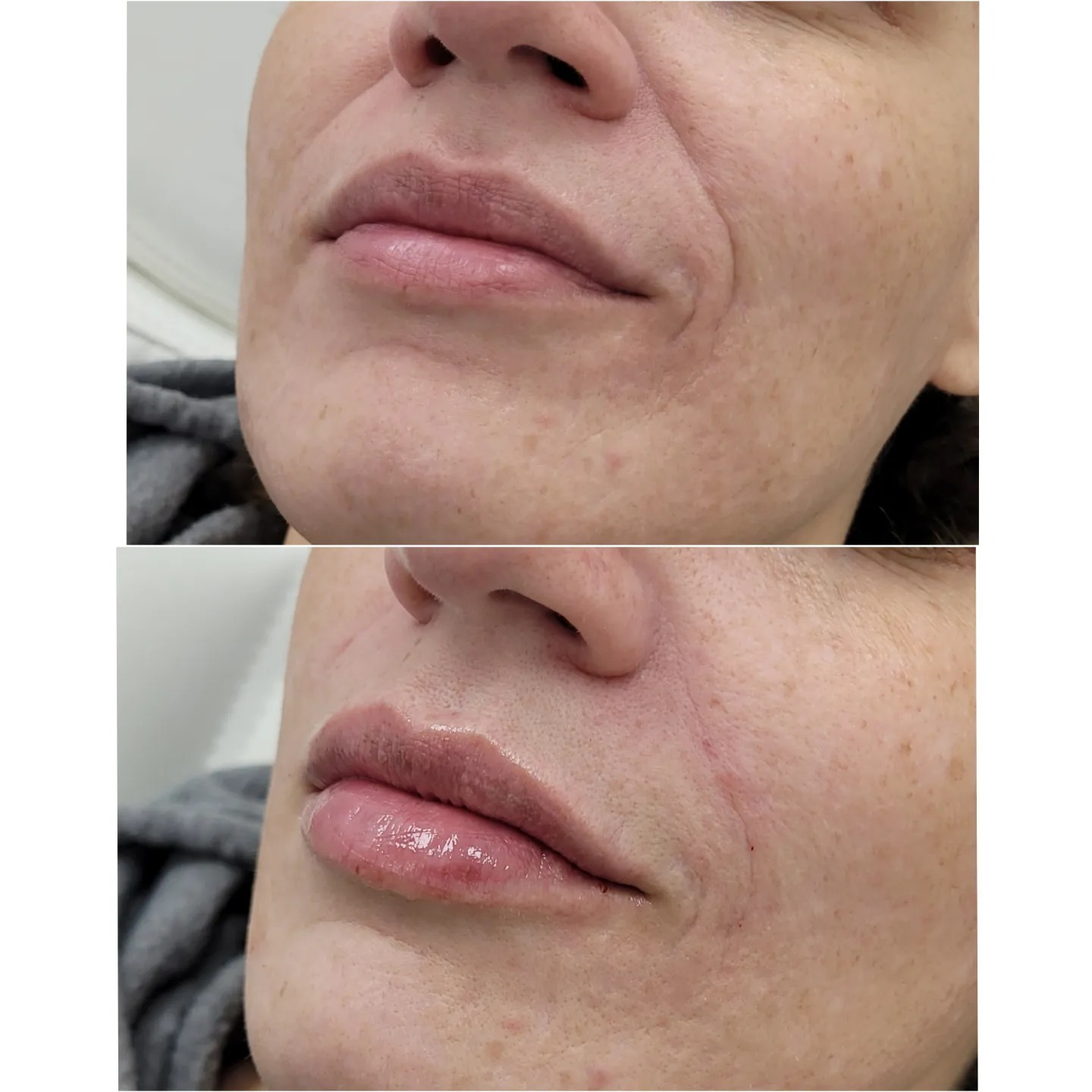 A little filler from the RHA... - Injections by Joanne Asia | Facebook