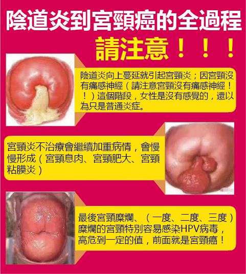 茵滋 從陰道炎到宮頸癌的全過程 陰道炎 宮頸炎 宮頸息肉 肥大 宮頸糜爛 宮頸癌 病來如山倒 其實真的不是的 所有嚴重的問題 都是在最初的時候 妳不引起重視 或者選擇了不正確的治療方法 慢慢積累惡化而來的 切記 別讓最好治愈的陰道炎發展成宮頸癌