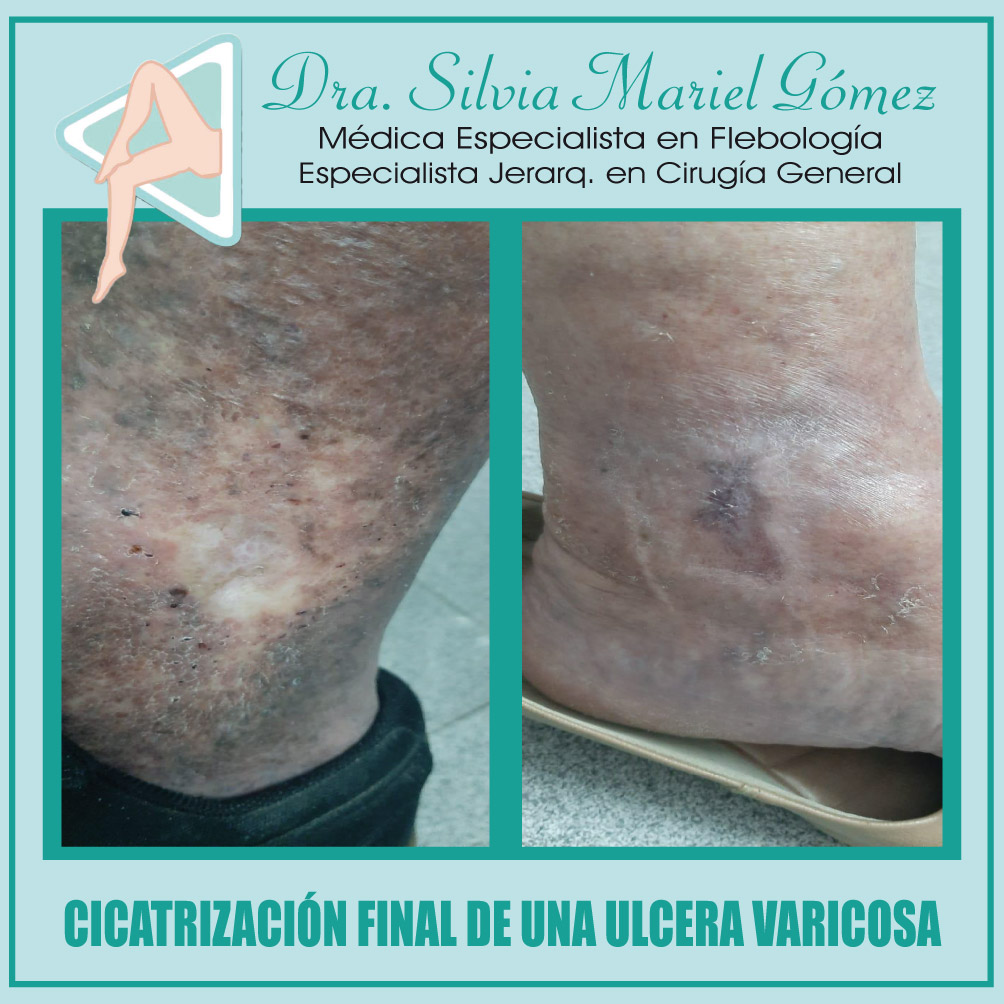 Flebología Dra. Silvia Gómez - La úlcera varicosa es el estadio final ...