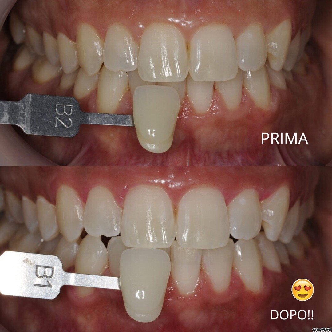 dental silicon ring - Acquista dental silicon ring con spedizione gratua su AliExpress version