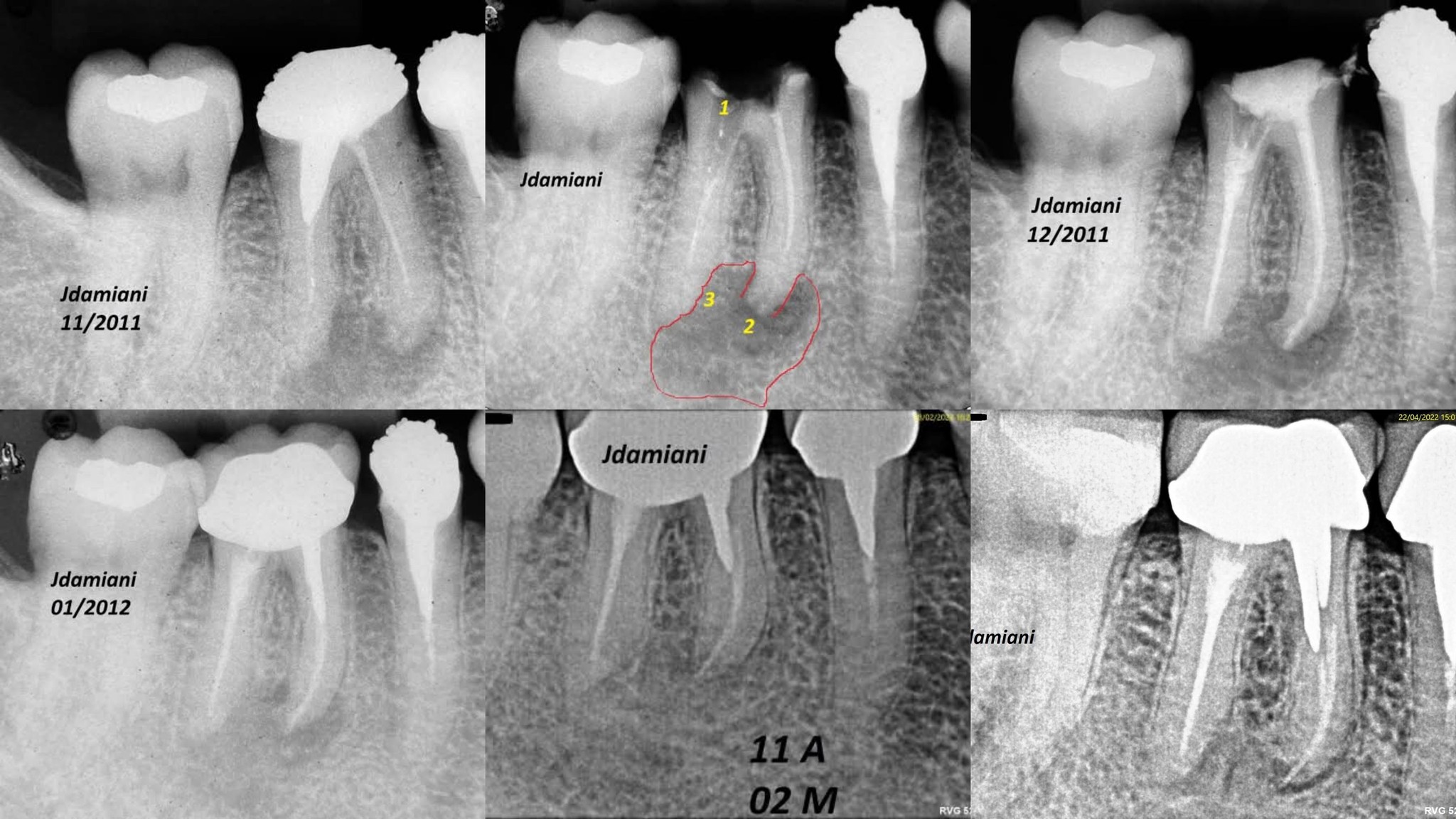 Resolving endodontic treatment challenges with delicate obturation