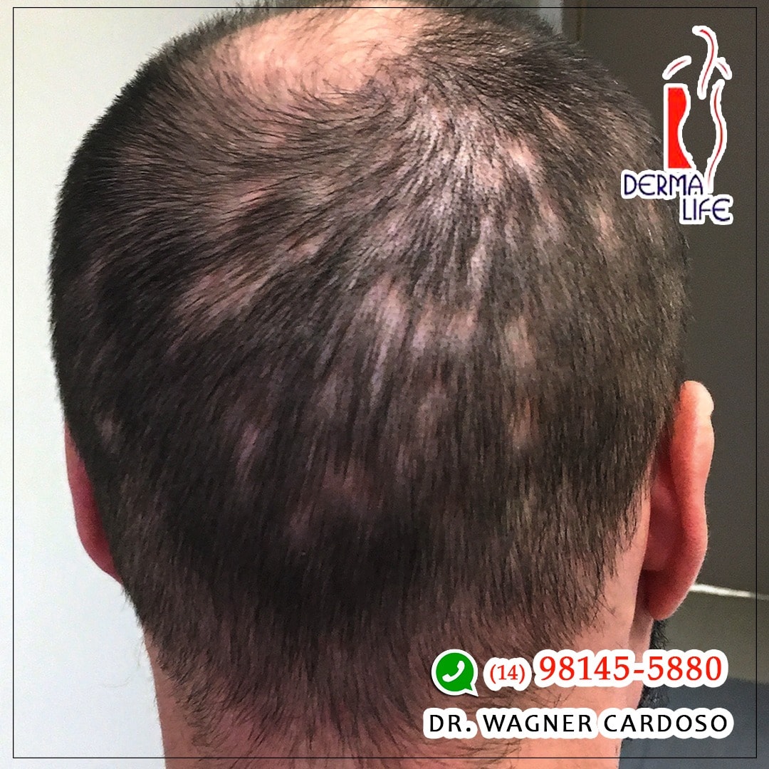 🗣️Alopecia é um termo que representa um... - Derma Life Bauru | Facebook
