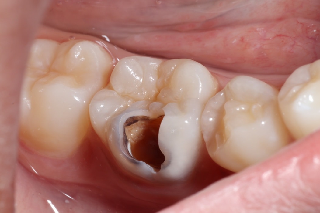 A case of RCT + Composite Overlay... - Rajput's Dental Care