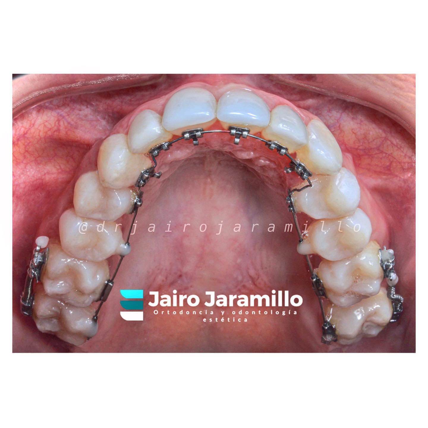 Dr Jairo Jaramillo - 👨🏻‍⚕️Ortodoncia lingual, con algunos tubos de # ...