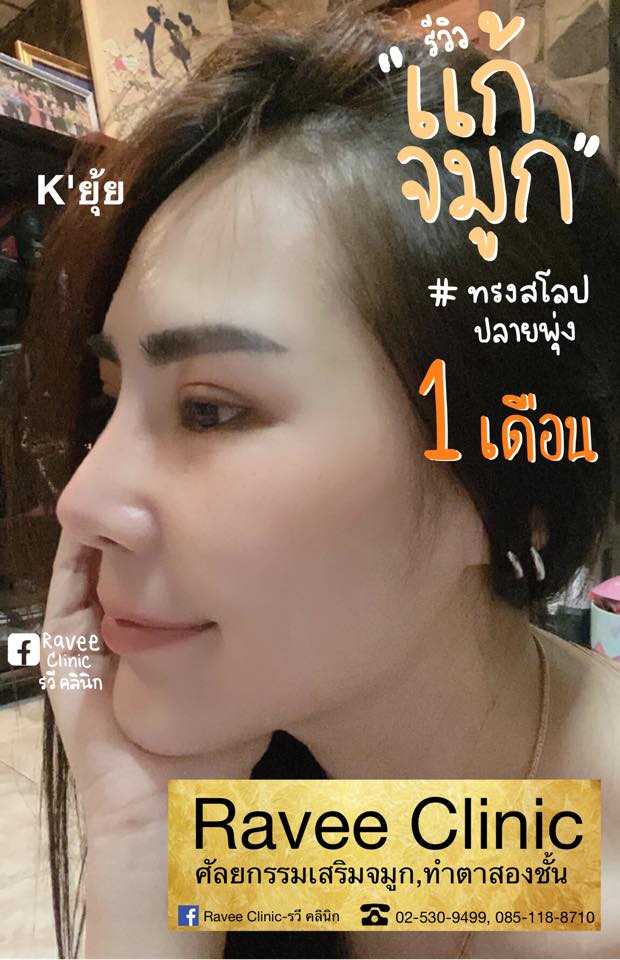 ‼️‼️โปรเสริมจมูก/แก้จมูก เหลือ... - Ravee Clinic - รวี คลินิก | Facebook