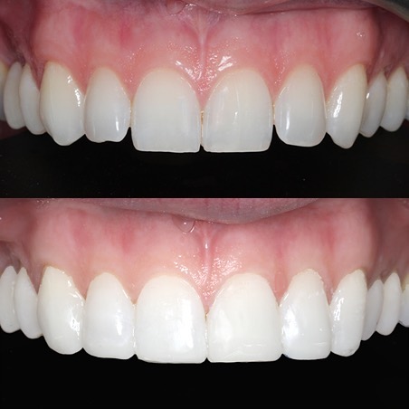 Muse Dental - 😬 No Braces! 😬 Some simple treatments like ‘edge bonding ...