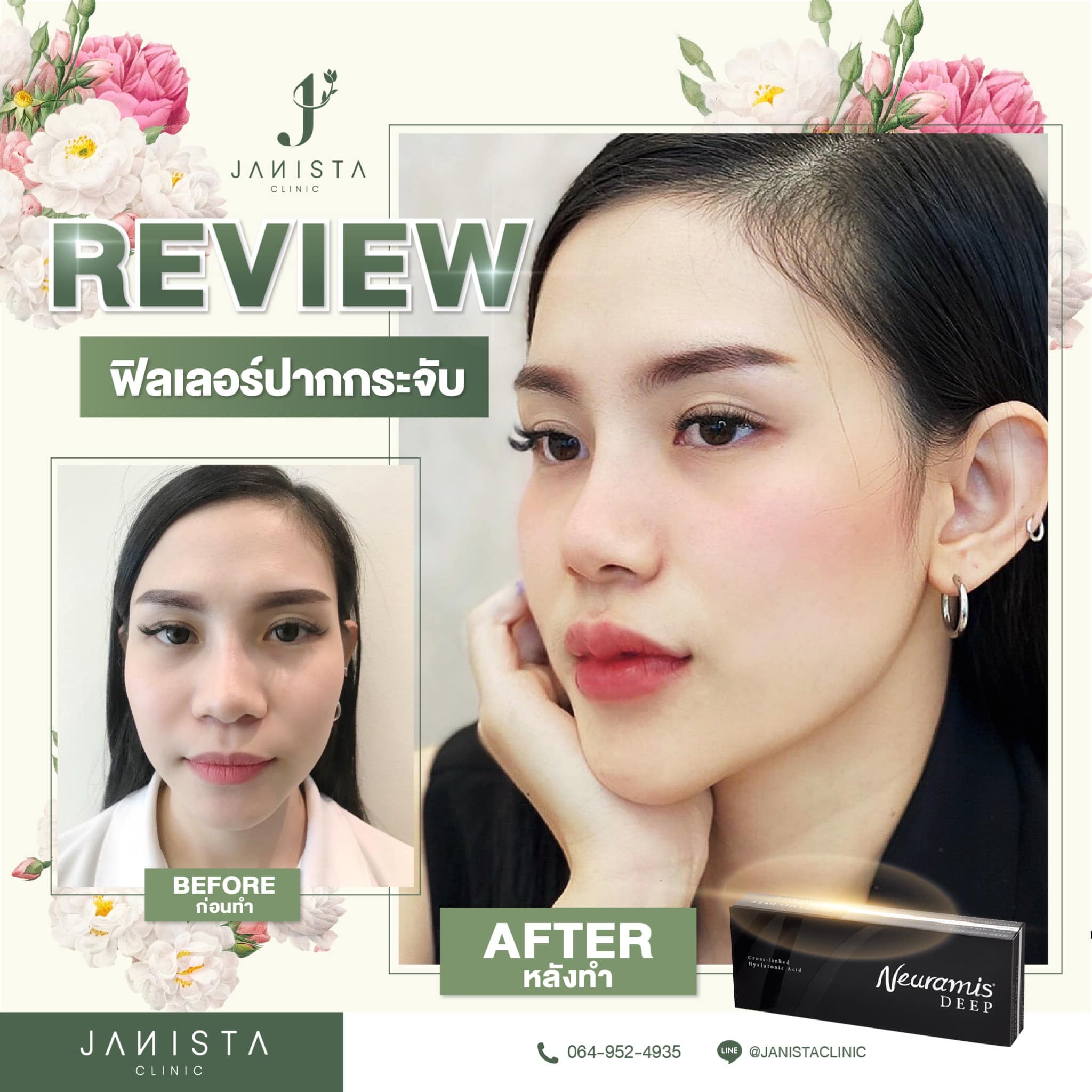 #รีวิวฟ... - Janista Clinic - เจนิสต้า คลินิกความงาม เชียงใหม่ | Facebook