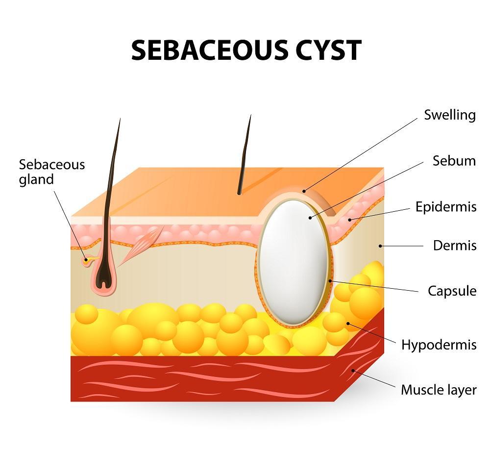 Exploring Different Types of Cysts and Their Removal Procedures Cysts ...