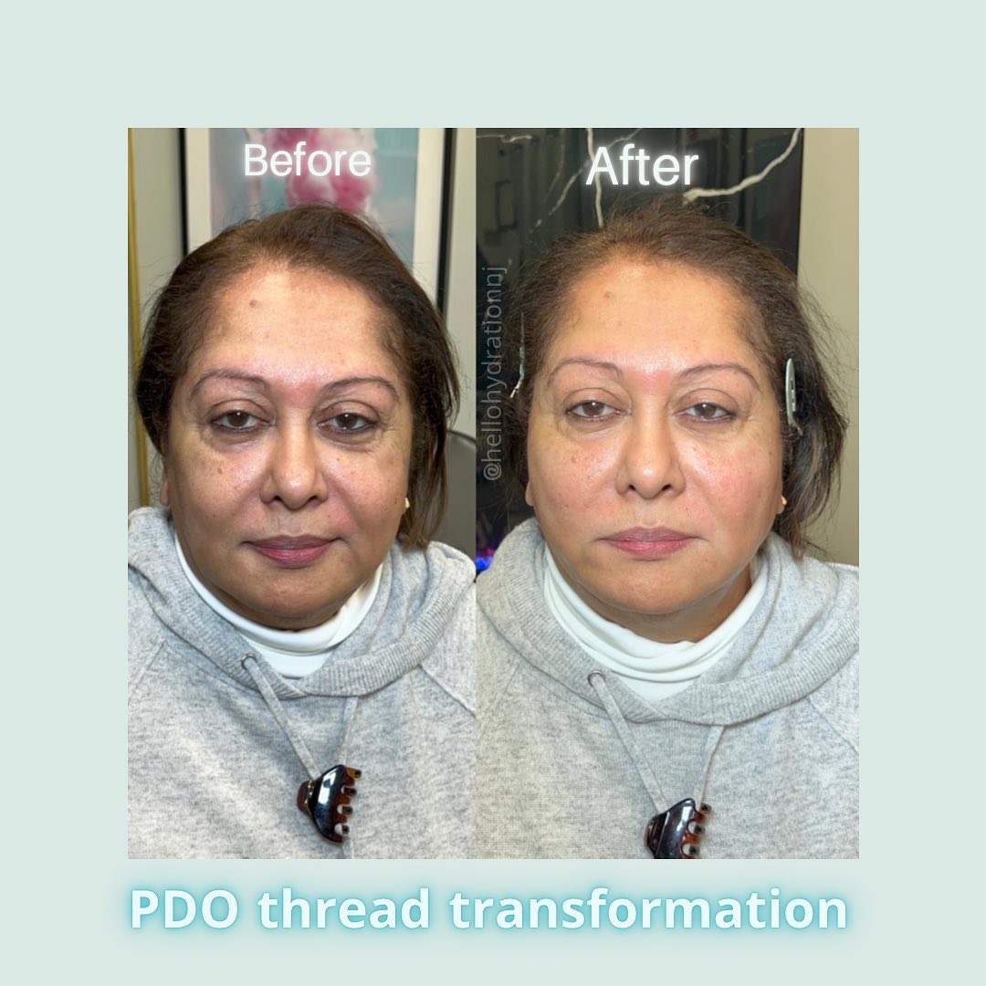 Hello Hydration - Beautiful natural PDO thread lift 👇 Mid...