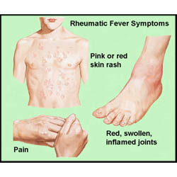 ไข้รูมาติก = ไข้ ปวดข้อ? ไข้รูมาติก (Acute rheumatic fever) เป็นกลุ่ม ...