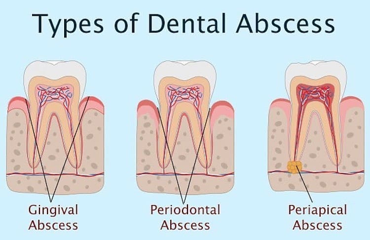 meno_doctor - Dental abscess is a pocket of pus in a tooth caused by an ...