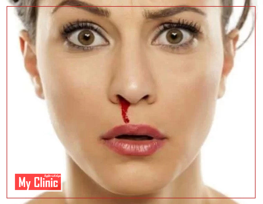 🔻 رعاف الأنف عند... - My Clinic عيادات ماي كلينك الطبية | Facebook