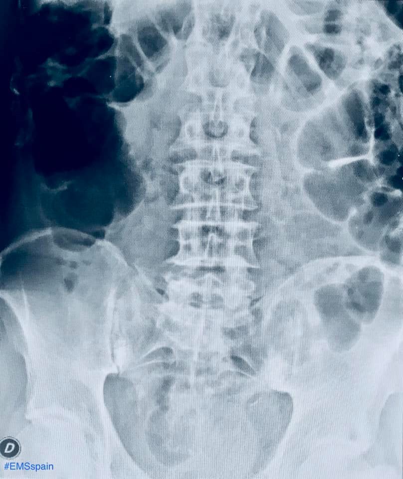 EMS Spain - Con frecuencia llegan a nuestras consultas dolores ...