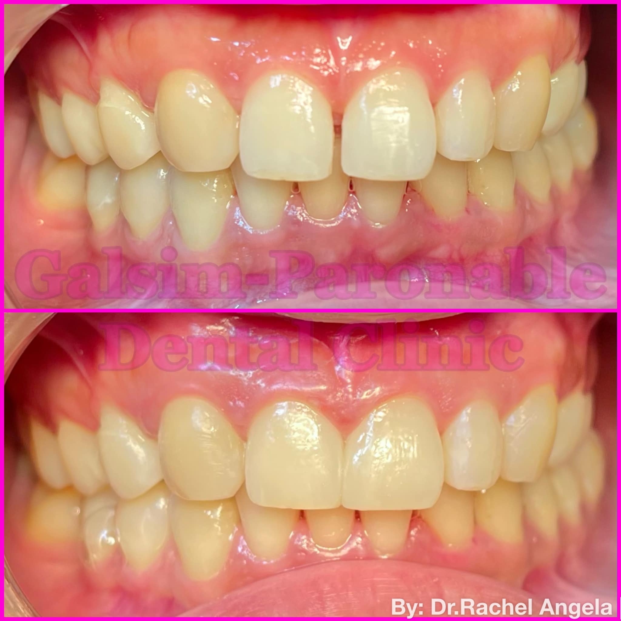 What is a diastema and how to close it