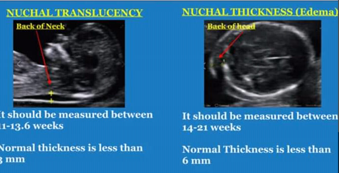 Increased Nuchal Translucency Ultrasound In