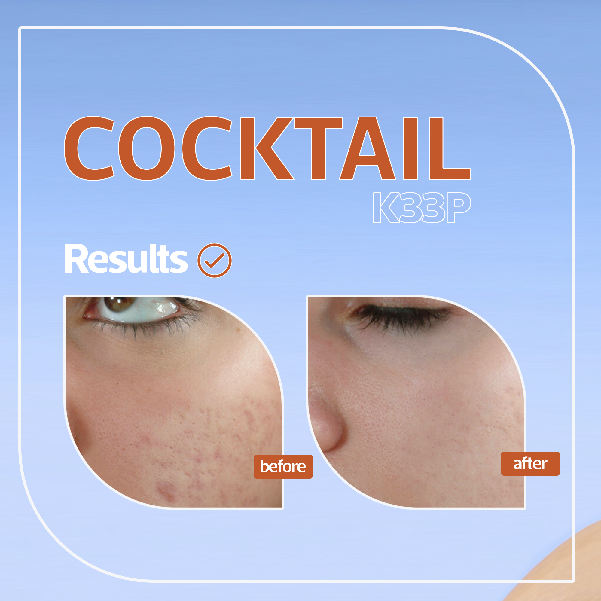 mccm glutathione cream reviews 🔸Looking for a skin whitening peeling: K33P by medical🔸 . ✔️It provides a remarkable reduction in all type of pigmentation and freckles. . ✔️It is not photosensitive – no need to Magic Glutathione: often referred to Size:15 Tabs