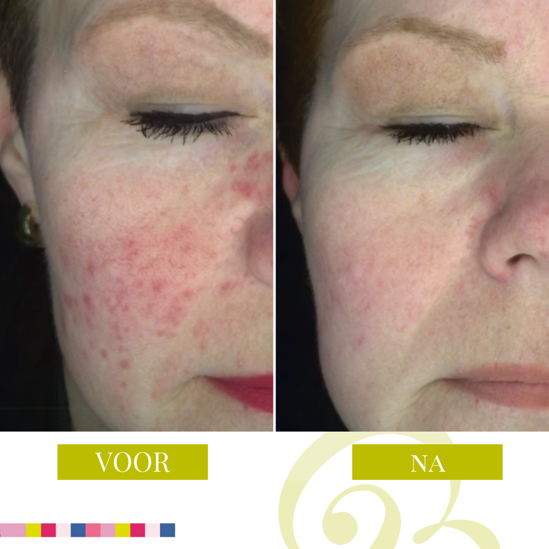 Een mooi effect van... - Laserkliniek Zwolle-Huidtherapie