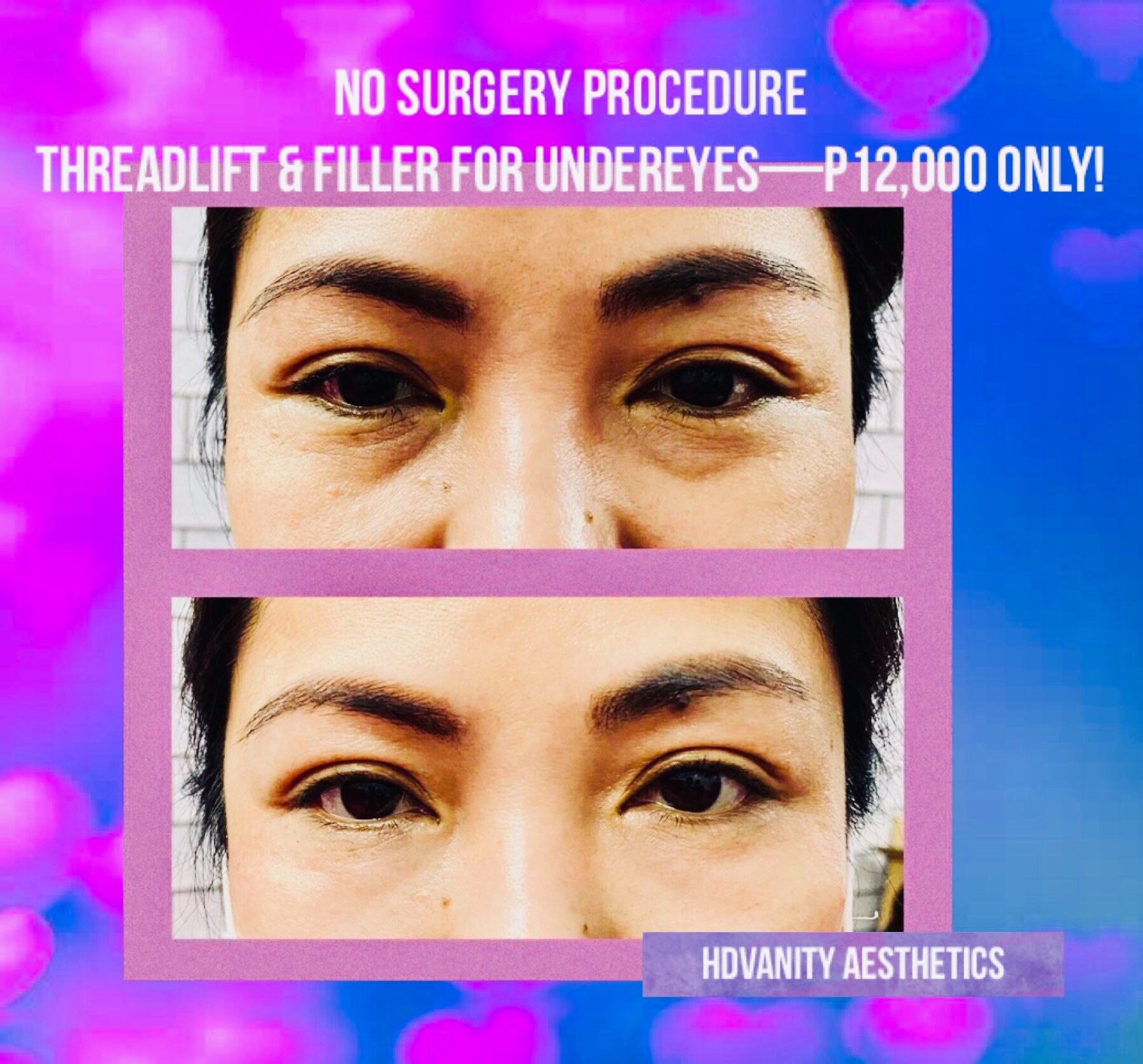 ♥️No Surgery Procedure for... - Vanity Aesthetic and Cosmetic