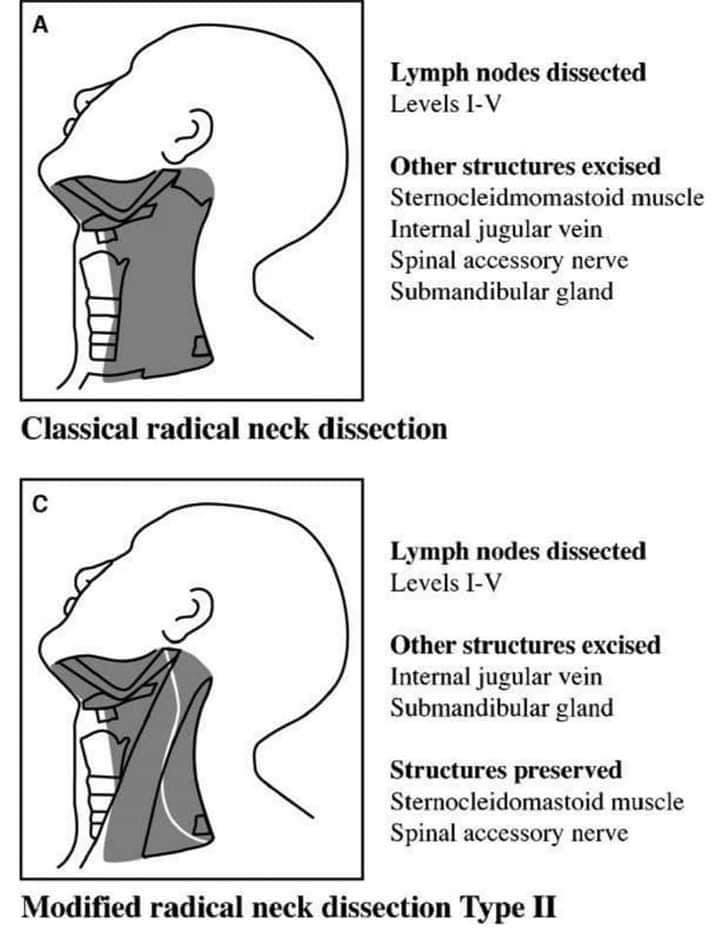 TYPES OF CERVICAL LYMPH NODE DISSECTION - Dental Desk Academy | Facebook