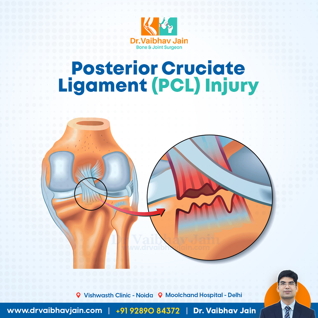 Anatomy of Posterior Cruciate Ligament... - Dr. Vaibhav jain | Facebook