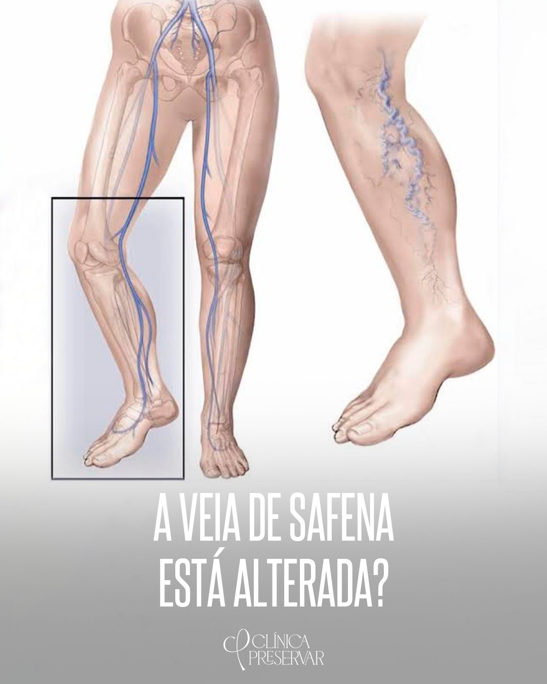 Você sabia? A veia safena é a maior... - clinicapreservar